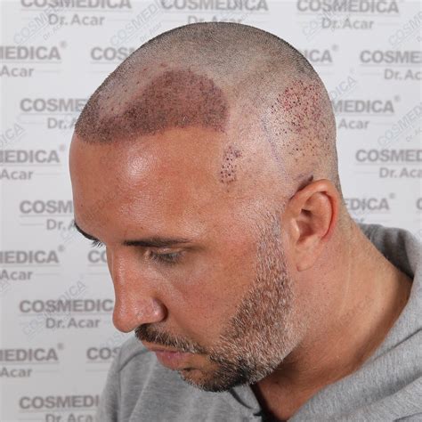 keiran lee hair transplant|58 Celebrities with Hair Transplant (Cost, Before & After).